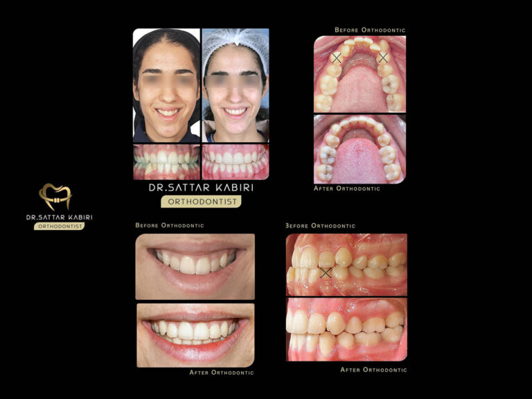 نمونه درمان با کشیدن دندان